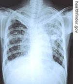 Tuberculosis is a bacterial infection that usually attacks the lungs.