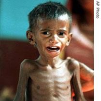 A 2-year-old severely undernourished boy in Maharashtra state, India, during a drought in 2001