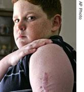 A 13-year-old boy shows the scar from the removal of a cancerous growth on his arm